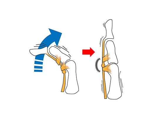 ばね指は放っておいても大丈夫？